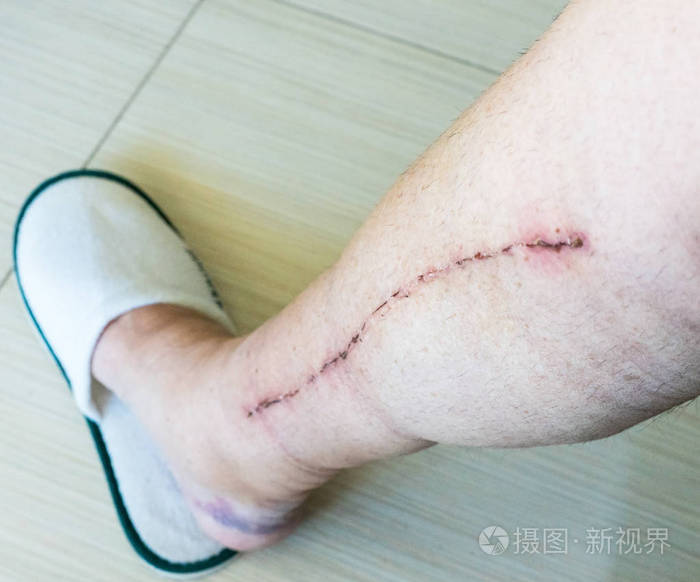 男性人腿与冠状动脉病变心脏手术瘢痕的选择性聚焦