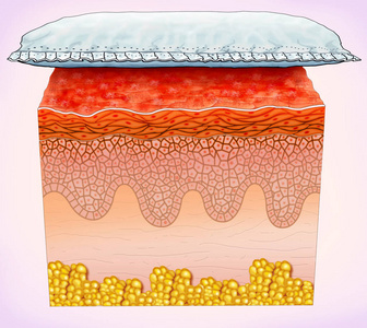这是一种皮肤疾病，在与尿布直接接触的部位可能会刺激真皮表皮作为外生殖器