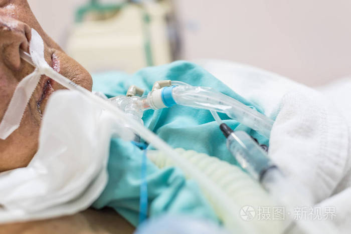 病人亚洲老年妇女80年代做气管切开使用呼吸机呼吸呼吸帮助病人床在