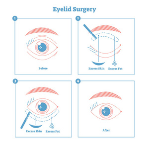 眼睑手术方案说明。多余的皮肤和脂肪去除整形手术。现代简约线型设计女性时尚与美容信息材料