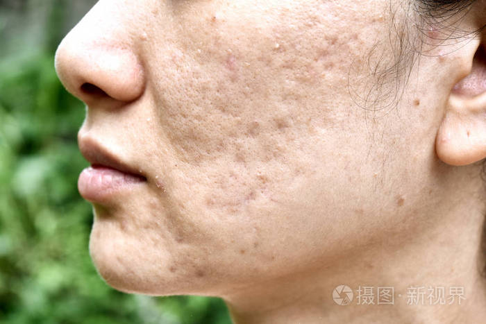 皮肤问题与痤疮疾病密切女人脸与白头粉刺月经爆发疤痕和油性油腻的