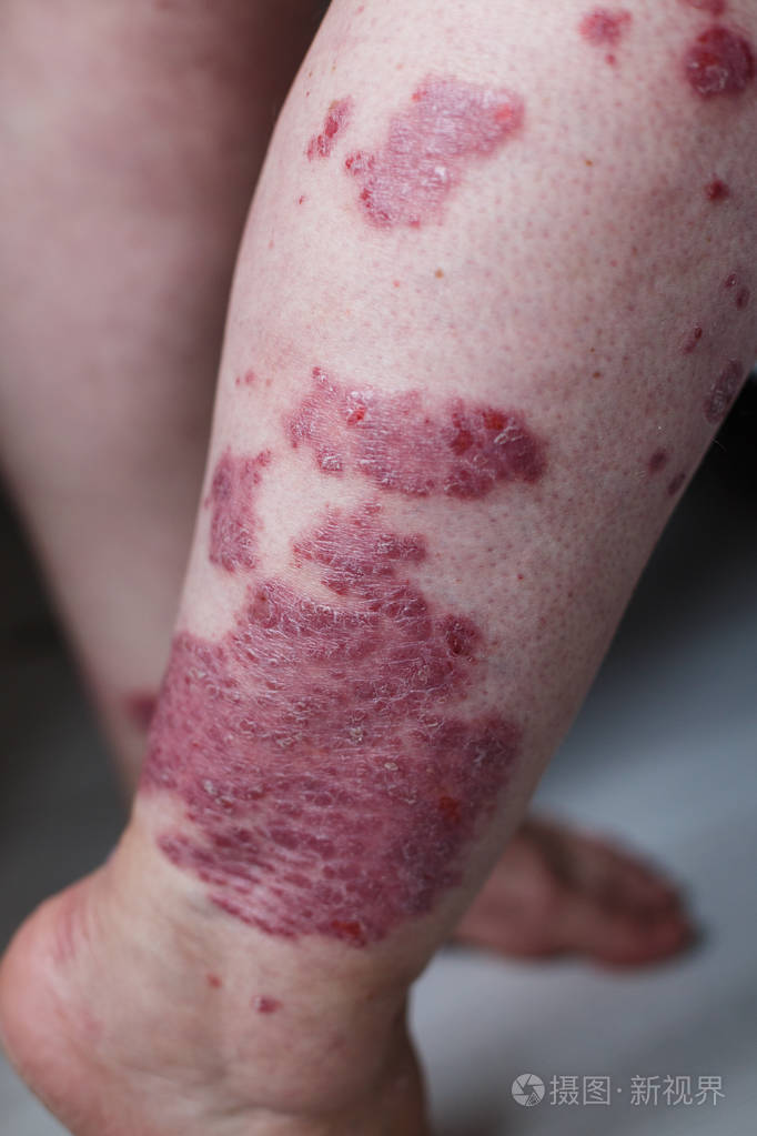 特写过敏性皮疹湿疹皮肤的病人特应性皮炎症状皮肤细节质地真菌皮肤