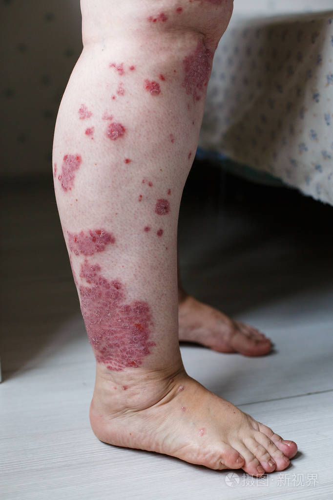 特写过敏性皮疹 湿疹皮肤的病人 特应性皮炎症状皮肤细节质地 真菌