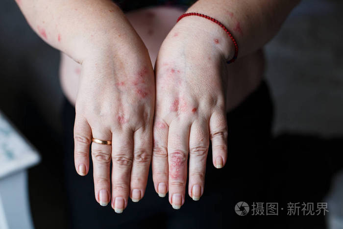 寻常的银屑病在女人手上有斑块皮疹和皮肤上的补丁自身免疫性遗传疾病