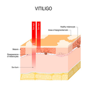 白癜风。 是一种皮肤状况，其特征是部分皮肤失去色素。 它发生在皮肤色素细胞黑素细胞死亡或无法发挥作用时。 教育医学生物和