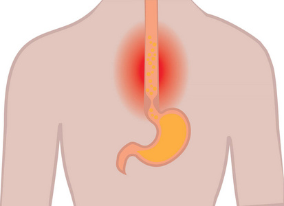 胃食管反流病。人体内胃胃灼热的流媒例证