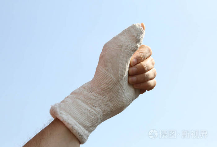 骨折的手和石膏在医院里拇指向上呈类似的迹象