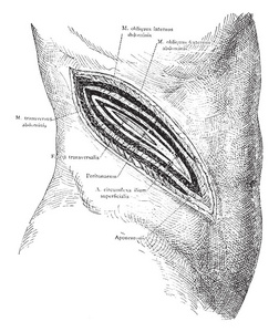 这个插图代表手术切口到肾脏，复古线绘图或雕刻插图。