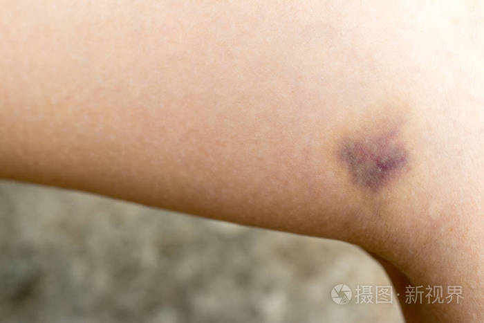 女性腿部瘀伤闭合