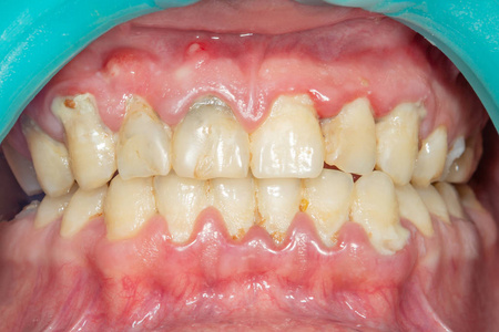 s teeth after removing and cleaning a plaque in a dental clinic.