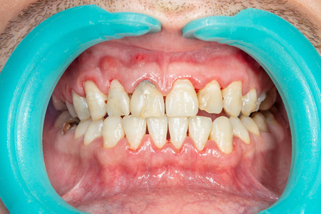 s teeth after removing and cleaning a plaque in a dental clinic.