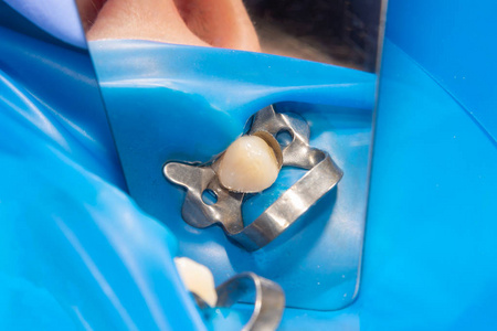 龋病治疗后上颌骨的两颗咀嚼侧牙。利用橡胶坝系统用光聚合物填充材料修复咀嚼面