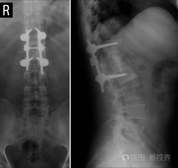 腰椎x线检查.椎体压缩性骨折l1.脊椎融合.