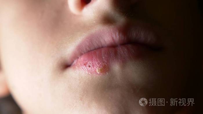 一个男孩的嘴唇疱疹疱疹唇部处理复制空间