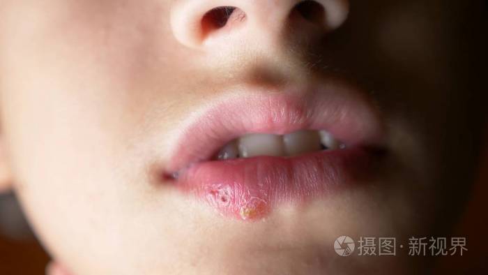 一个男孩的嘴唇疱疹.疱疹.唇部处理, 复制空间