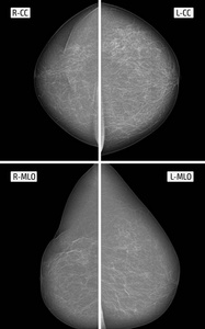 乳房X光检查。 右胸手术。 纤维化。