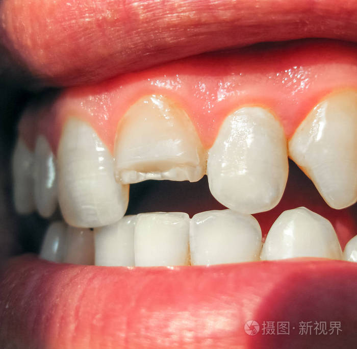 断了的牙齿. 人嘴上切牙折断. 男人向牙医展示口腔. 治疗断牙.