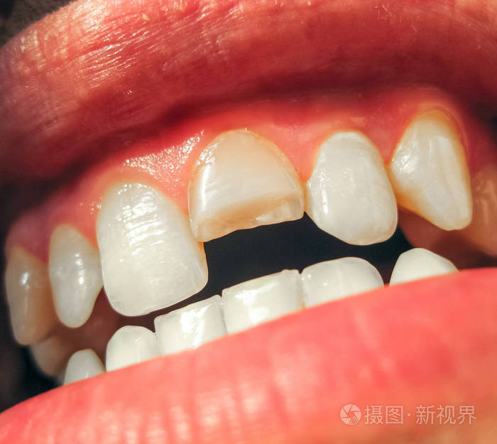 人嘴上切牙折断. 男人向牙医展示口腔. 治疗断牙.