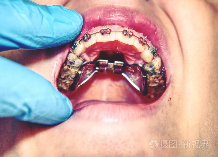 卫生快速扩张器(hyrax)带状设计为上弓快速腭扩张器.