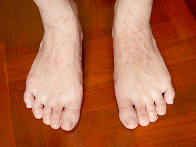 s feet caused by allergic eczema. Health and skin problems.