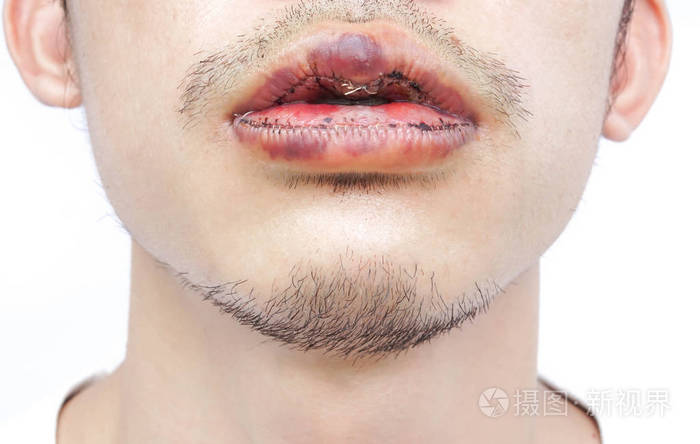 特写嘴唇男人上下与复位手术美容理念