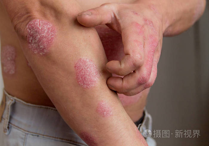 手臂和腹部牛皮癣的男子