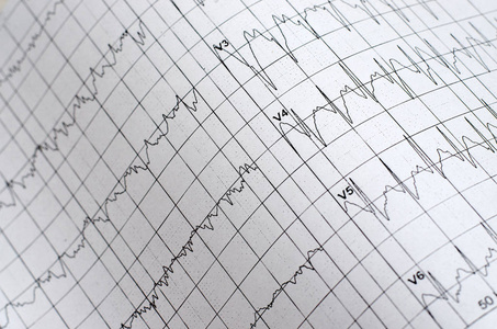 心电图图作为医学背景..关门