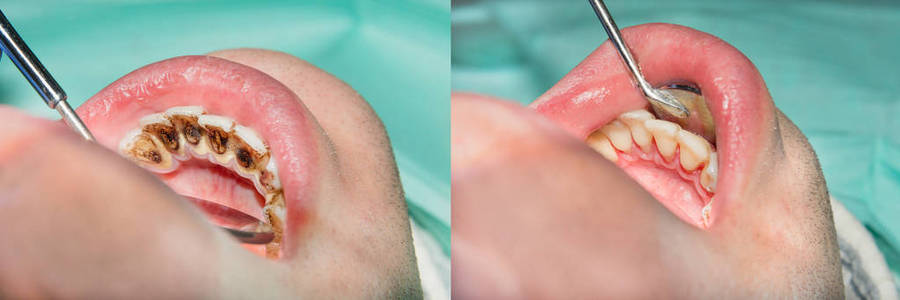 病人结石的斑块。 牙科治疗牙菌斑专业口腔卫生。 吸烟及清洁牙齿的危害概念