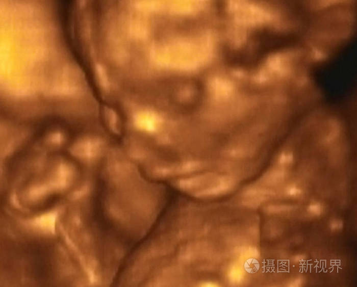 意大利第4个月胎儿超声分析