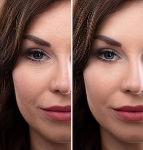 s Face Before And After Cosmetic Procedure