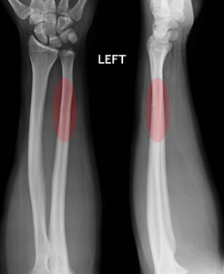  ulnar bone, xray film