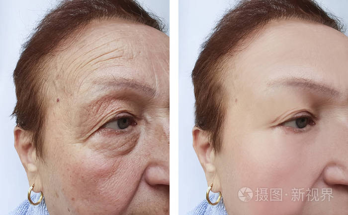 老年妇女在治疗前后出现皱纹