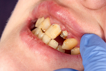 牙针关闭准备牙齿的配方陶瓷冠。 牙科修复术的概念