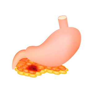 胰腺炎。 胃和胰腺的结构。 信息图表。 孤立背景的矢量图