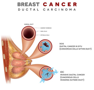 乳腺癌解剖插图乳腺导管癌详细医学插图。 白色背景下正常导管癌原位癌和浸润性导管癌