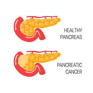 胰腺癌的概念。向量例证
