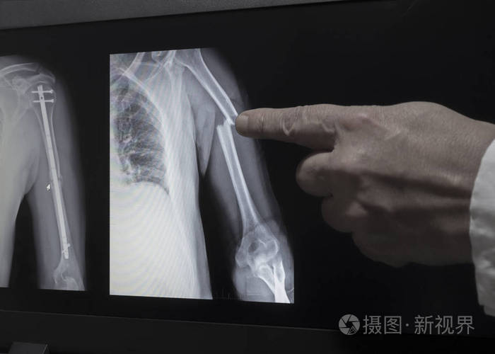 照片 在监视器屏幕上显示一只手骨折的x射线,医生的手指向骨折.