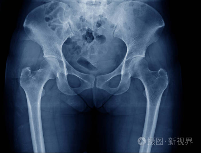 髋部和骨盆骨x线