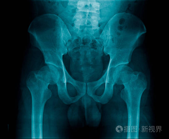 髋关节退行性改变老人髋关节疼痛x线骨盆骨和髋关节骨
