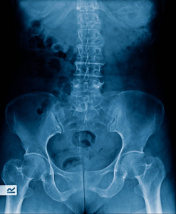 高质量的人脊柱X线表现为腰椎退行性改变和胸椎骨盆轻度颈椎病