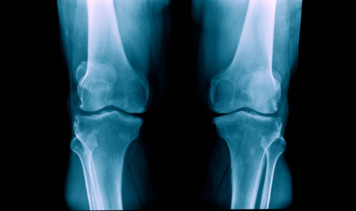 X射线膝盖
