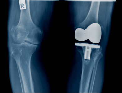 膝关节置换术后TKA X射线图像高质量X射线
