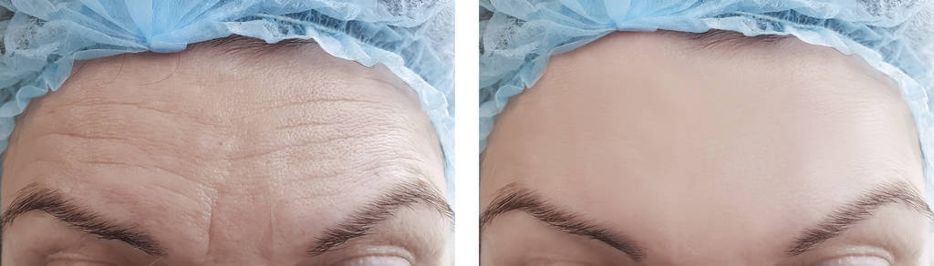妇女在手术前后皱纹前额图片