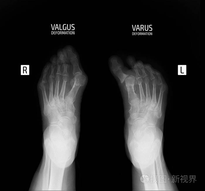 第一指内翻和外翻畸形.照片-正版商用图片