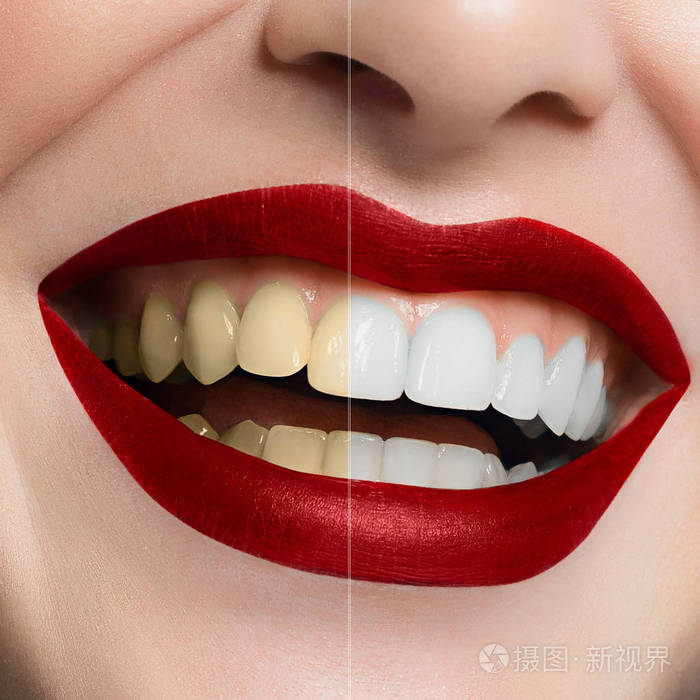牙齿美白和清洁牙齿护理. 美白漂白处理前后