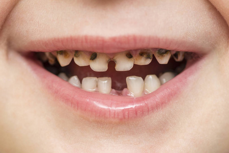 孩子病人张开嘴，露出蛀牙，牙齿腐烂。 关闭不健康的婴儿牙齿。 牙科医学和保健人类病人张口显示龋齿蛀牙