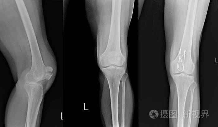 x线左膝侧方显示膝关节骨折,k线膝关节术后固定.