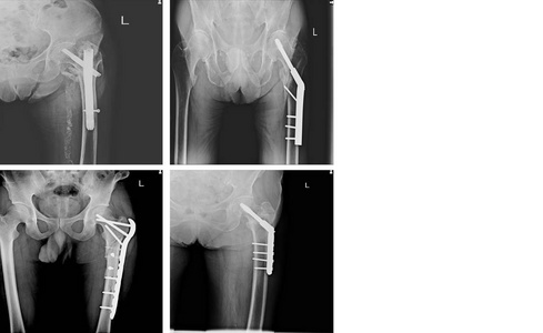 X射线采集骨科手术多髋关节人体手术及钢板和螺钉内固定与复制空间。