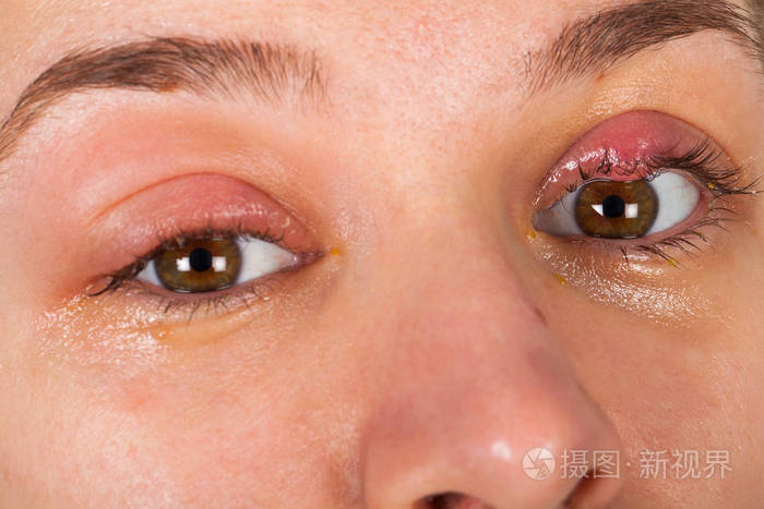 上睑炎症的特写照片,霰弹枪,年轻女性,感染病毒