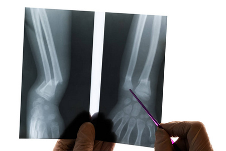 医生手里拿着一个指针，照片上显示出骨折。 孤立的桡骨和尺骨X线。 医务工作者放射科医生的一天。 白色背景。